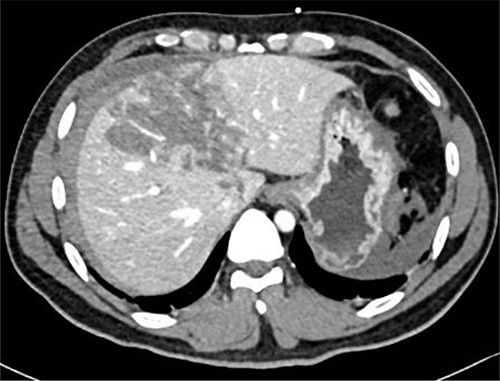 Contrast-enhanced CT scan showing Grade IV liver laceration.