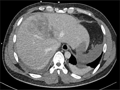 Repeated CT scan on Day 5 showing liver laceration with no evidence of hepatic pseudoaneurysm.