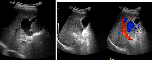 Abdominal US revealing a right hepatic artery pseudoaneurysm.