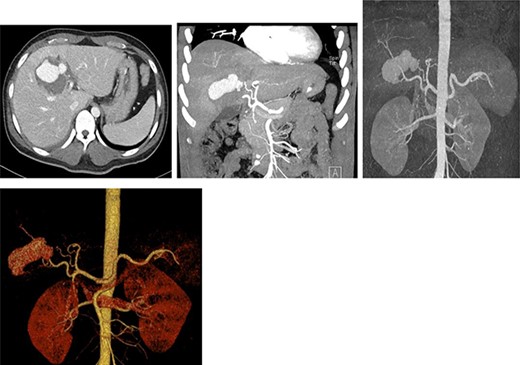 Contrast-enhanced CT scan revealing a right hepatic artery pseudoaneurysm in the right lobe of the liver.
