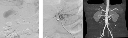 (a) Arteriogram showing a hepatic artery pseudoaneurysm in the right hepatic artery; (b) shows post-embolization selective arteriogram showing disappearance of the pseudoaneurysm in the right lobe of the liver; CT angiogram shows successful embolization (c).