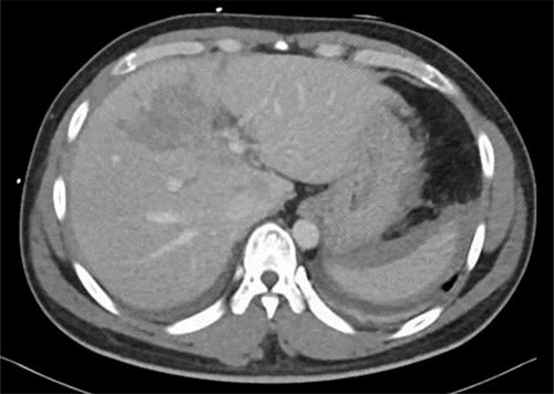 Repeated CT scan of the abdomen after 4 weeks revealed partial healing of the liver injury with disappearance of the pseudoaneurysm.