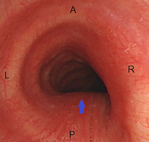 Endoscopic view of the trachea during tele-bronchoscopy; there is circumferential narrowing of the lumen, more prominent on the posterior and right sides (arrow); A, anterior; P, posterior; R, right; L, left.