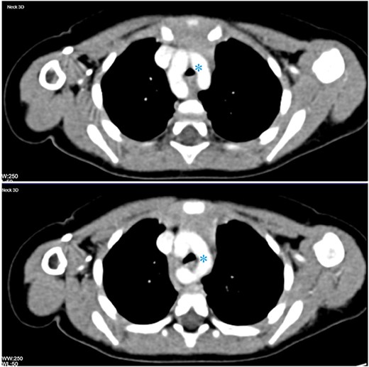 Contrast-enhanced CT of the chest in two consecutive axial cuts showing duplication of the aortic arch encircling the thoracic trachea and oesophagus (asterisk).