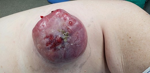 Right chest wall cutaneous mass.