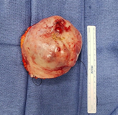 Gross specimen of right chest wall cutaneous mass.