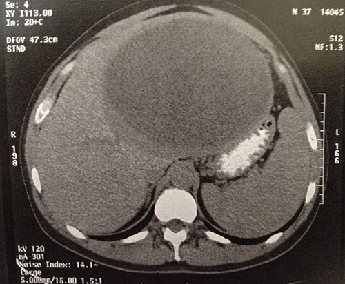 Computer tomography image showing a 23 × 22 × 16-cm lesion arising from the left lobe of the liver.