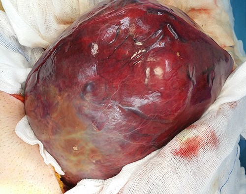 Intraoperative view of the tumor before its resection.