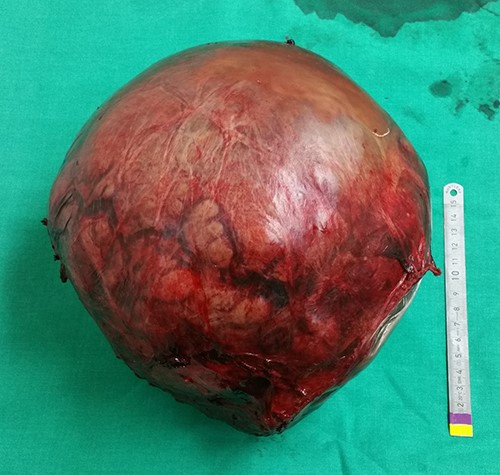 Intraoperative view of the tumor after its resection.