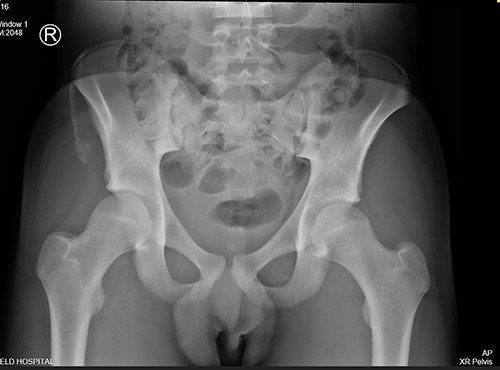 AP radiograph following injury, demonstrating a large avulsion from the right hemipelvis, including the ASIS and portion of the IC apophysis (R - Right).