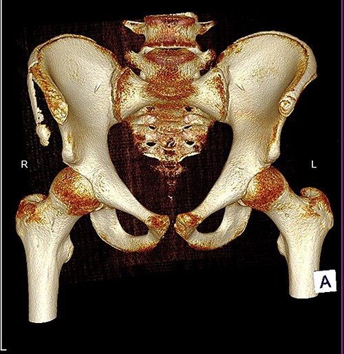 3D reconstruction of tomographic CT scan illustrating avulsion fracture of ASIS and IC apophysis with its latero-inferior displacement (R - Right, L - Left, A - Anterior).