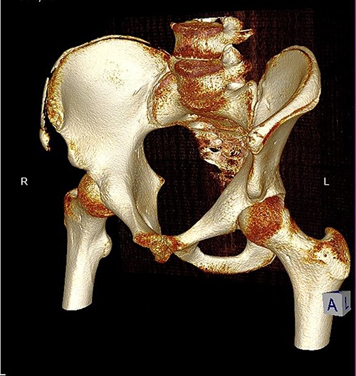 3D reconstruction of tomographic CT scan illustrating avulsion fracture of ASIS and IC apophysis with its latero-inferior displacement (R - Right, L - Left, A - Anterior).