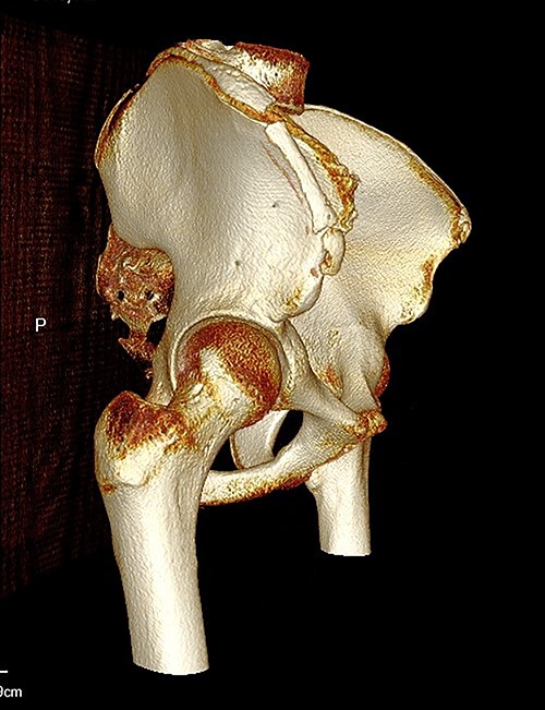 3D reconstruction of tomographic CT scan illustrating avulsion fracture of ASIS and IC apophysis with its latero-inferior displacement (P - Posterior).