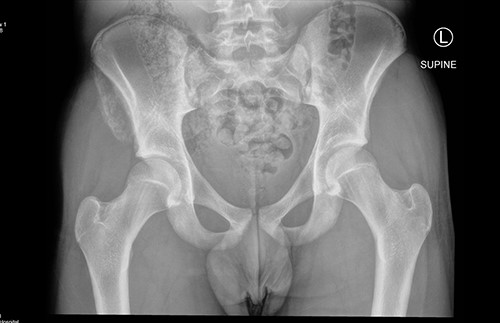 Plain AP radiograph 4 weeks following injury, demonstrating callus formation between avulse bony fragments and right hemipelvis (L - Left).