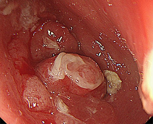 Upper gastrointestinal endoscopy showed a tumor at the pyloric region of the gastric tube causing pyloric obstruction.