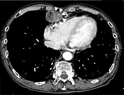 Preoperative CT image; white arrows indicate a tumor with thickening of the gastric wall.