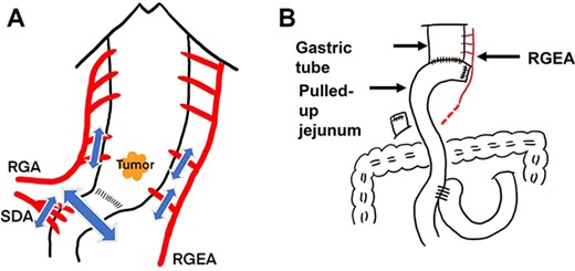 Diagrammatic representation of the intraoperative findings; (A) resection of the distal gastric tube with preservation of the RGEA and RGA and (B) Roux-en-Y reconstruction; SDA, supra-duodenal artery; p-ring, pyloric ring.