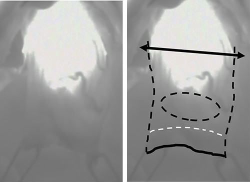 Intraoperative visualization of the blood flow in the proximal side of the gastric tube using ICG fluorescence; bilateral arrow: dissection line of the proximal margin; black dotted line: outline of the proximal part of the gastric tube; black solid line: distal surgical margin; white dotted line: pylorus; black dotted circle: location of the tumor.