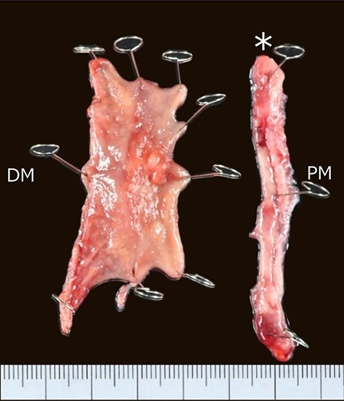 Resected specimen; a Type II tumor in the pyloric lesion of the gastric tube measuring 25 × 15 mm in size; PM, proximal margin; DM, distal margin; asterisk, surgical specimen removed by circular staple.