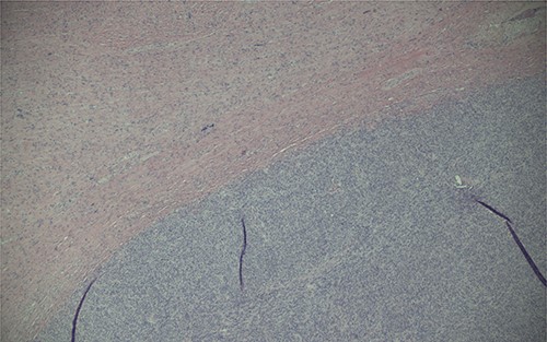 Magnification (40x) of histologic section of prostate, showing STUMP (upper left of image) and adjacent sarcoma (lower right of image).