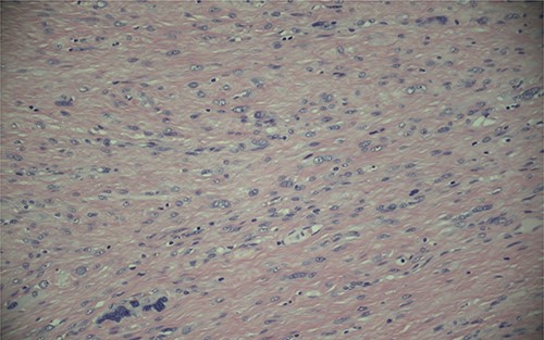 Magnification (200x) of histologic section of prostate, showing STUMP with severe cytologic atypia and no increase in mitotic activity.