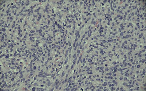Magnification (400x) of histologic section of prostate, showing stromal sarcoma with moderate cytologic atypia and brisk mitotic activity.