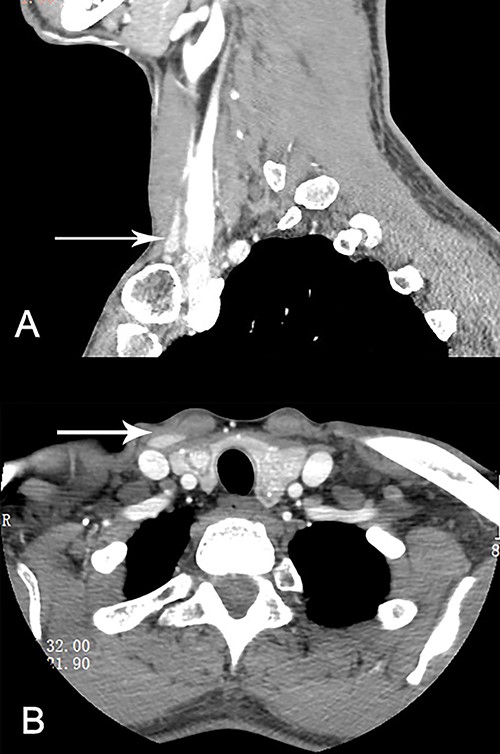 Ectopic lateral thyroid in CT (as is shown in white arrow in A and B).