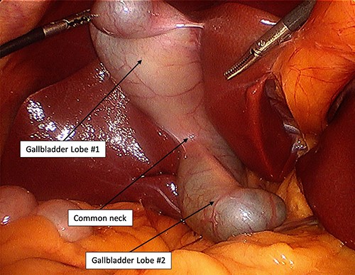 Intraoperative photograph of BG with common neck.
