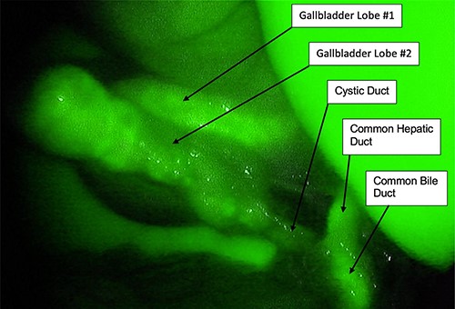 Intraoperative indocyanine green fluoroscopy showing a single cystic duct.
