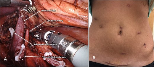 (A) Demonstrates robotic-assisted left nephrectomy. (B) Surgical incisions 10-day postoperatively.