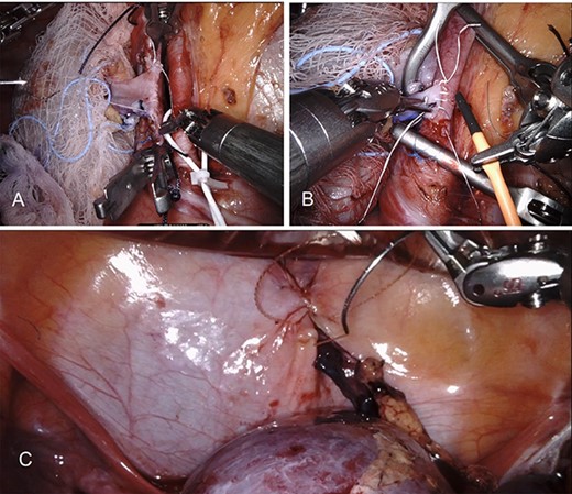 Demonstrates robotic-assisted autotransplant. (A) LRV to left external iliac vein anastomosis. (B) Left renal artery to left external iliac artery anastomosis. (C) Ureteral anastomosis with well-perfused kidney.