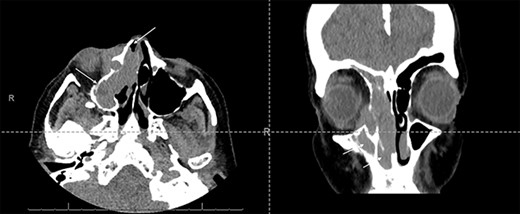 Axial and coronal CT sinus images showing an extensive soft tissue mass within the right maxillary sinus which completely obliterates the sinus cavity and extends into the right nasal cavity (arrows). It also involves the right ethmoid and frontal sinuses. The mass extended through the lamina papyracea into the right orbit, abutting and displacing the globe, and is seen to invade the nasolacrimal system.