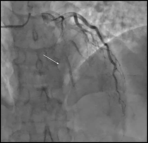 Coronary angiography showing subtotal occlusion of the LAD stent and severe in stent re stenosis of diagonal artery stent.