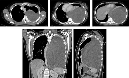 Axial, coronal and sagittal chest CT soft tissue window shows a large mass occupying the entire left posterior hemithorax measuring 12.3 cm (AP) × 14.4 cm (T) × 22.8 cm (CC) with associated partial collapse of the left lung and mediastinal shift to the contralateral side; the mass abuts to the descending aorta. No evidence of rib or thoracic spine destruction seen.