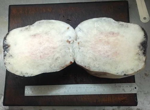 A well circumscribed tumor which is non-capsulated with firm white cut surface; neither hemorrhage nor necrosis noted.