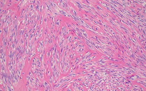 Histopathology of the lesion demonstrating monotonous population of spindle shaped cells in intersecting fascicles without cytological atypia; H&E stained sections 100× original magnification.