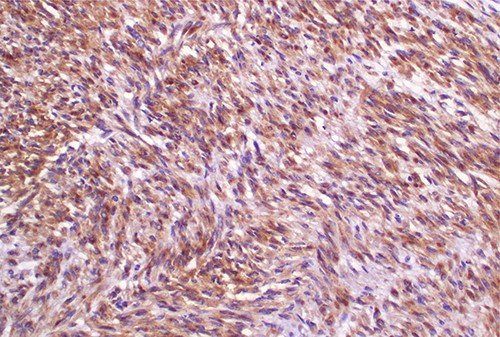 Photomicroscopy of the lesion highlighting positive immune-reactivity of the tumor cells with desmin immunostaining; IHC stained section 200× original magnification.