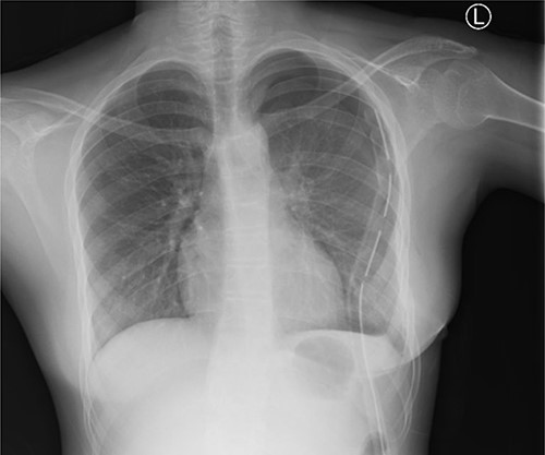 Chest X-ray (PA) shows no mass in the left hemithorax after thoracotomy and tumor resection; chest tube in situ; heart and lungs appear normal.