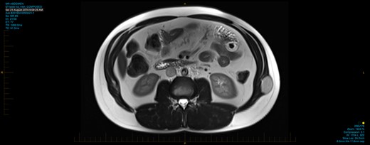 Axial section of abdominal T2 weighted MRI showing hyperintense mass within the left external oblique muscle.