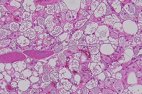 Histophotograph showing lobules of fat with multivaculated brown fat cells without evidence of dysplasia or necrosis.