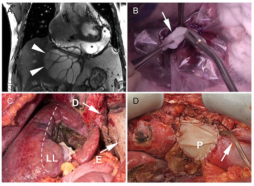 Cystic echinococcosis of the liver with pericardial involvement. (A) On magnetic resonance imaging, arrowheads indicate the right border of the cyst. Liver segments I–IV are atrophic due to the compression of the cyst (diameter 13.4 cm). Daughter cysts are detected in the pericardial effusion (asterisk); (B) to avoid dissemination and spilling of the cyst content, a plastic cover was sutured to the cystic wall before opening of the cyst. The parasitic cysts (arrow) were removed; (C) intraoperative situs after completed pericystectomy. The dashed line marks the anatomic border between segments V/VIII and IV. The diaphragm was infiltrated by the parasitic cyst (D) and resected with adjacent pericardium. The image shows the open pericardium with severe fibrinous pericarditis (E); (D) pericardial defect (P) was closed with a xenogeneic patch and a pericardial drain (arrow) was placed for postoperative irrigation with hypertonic saline solution (D).