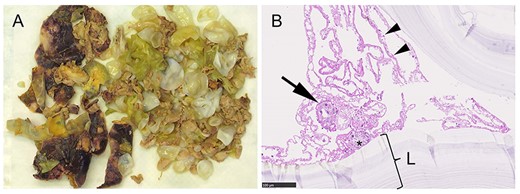 Macro- and microscopic specimens. (A) Resected cyst material consists of the darker cyst wall (white asterisk) and the yellow and white daughter cysts; (B) histology revealed multiple protoscoleces (black asterisk), one of them with a hook (arrow). The arrowheads point at the germline membrane, which corresponds to the inner layer of the cyst. The laminated membrane (L) is surrounding the germline membrane. The outermost layer, the pericyst, is not shown. It consists mainly of host cells.