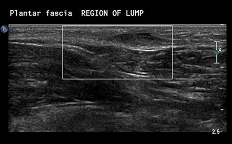 Ultrasonographic Images demonstrating the presence of a nodule embedded in the plantar fascia.