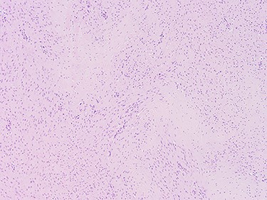 Images at ×4 magnification. Tissue samples comprise of cytologically bland spindle cell proliferative features which extends into the adjacent fibrofatty tissue.
