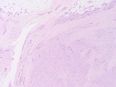 The cellular pattern is haphazard with areas of dense fibrosis, suggestive of fibromatosis (LD).