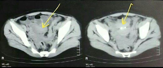 CT SCAN showing peritoneal mass.