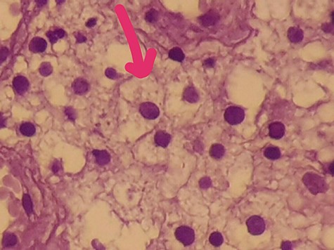 Foamy cells.