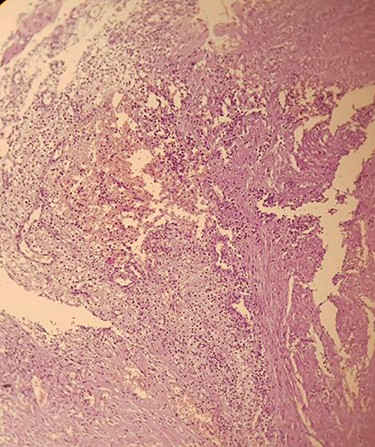 Aggregation of lipid laden macrophages (foamy cells) that is infiltrated by lymphocyte and neutrophils with blood vessels congestion.