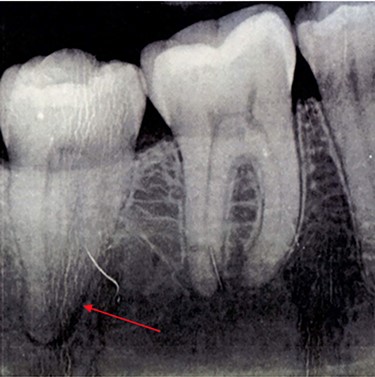 OPG taken on patient’s first visit to GDP. Demonstrates radiolucency at apex of LR7.