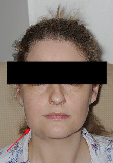 Photo taken on admission to RDH illustrating right-sided submandibular swelling.